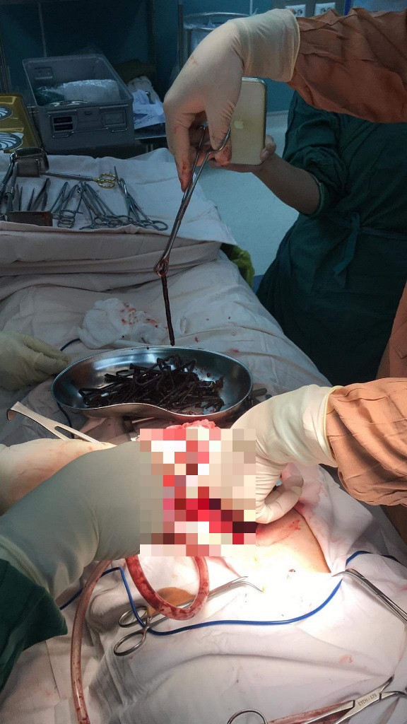 Bác sĩ 'choáng' khi phát hiện vô số đinh, thìa, lưỡi dao trong bụng nam bệnh nhân ảnh 2