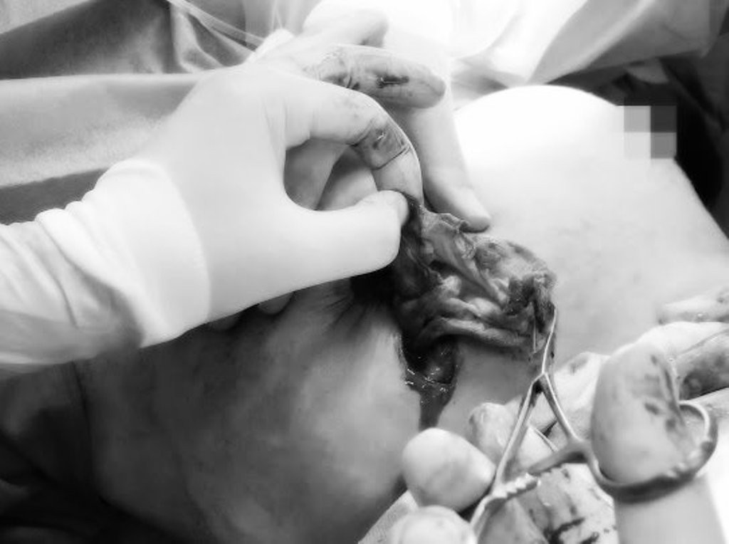 Điều bất ngờ khi kiểm tra cơ sở làm đẹp bỏ quên gạc trong ngực bệnh nhân ảnh 2