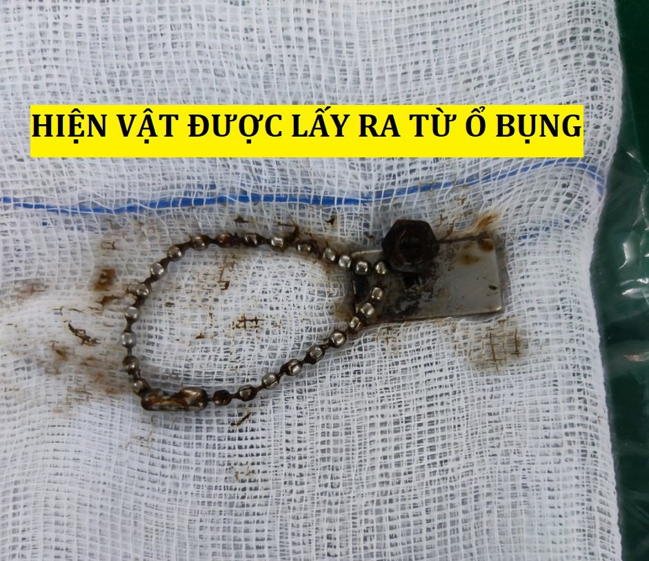 Bé trai thủng ruột do nuốt nam châm ảnh 1