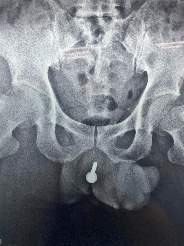 Say xỉn, người đàn ông bị bạn nhậu nhét ốc vít vào 'cậu nhỏ' ảnh 1