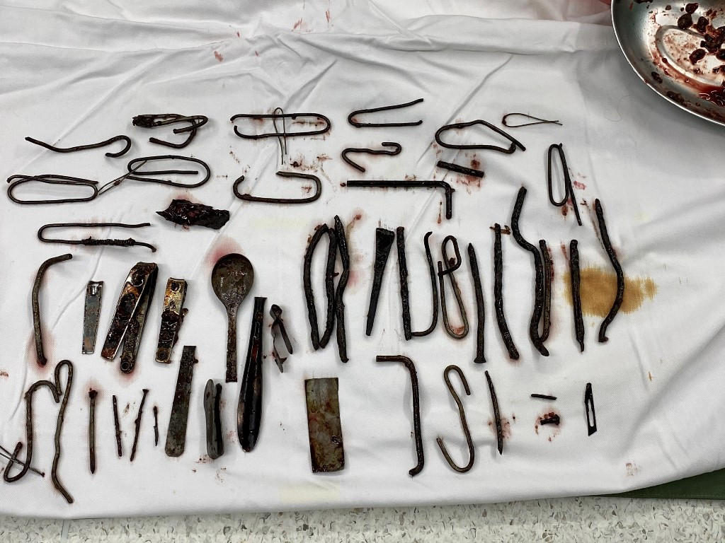 Bác sĩ 'choáng' khi phát hiện vô số đinh, thìa, lưỡi dao trong bụng nam bệnh nhân ảnh 3