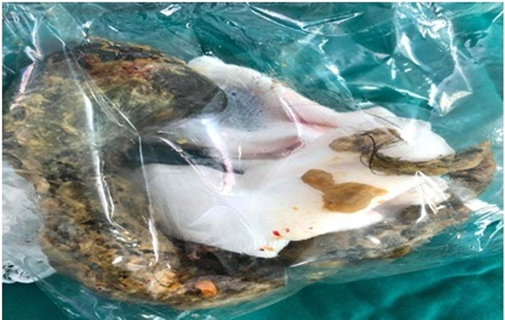 Bé gái 8 tuổi bị tắc ruột vì hội chứng 'nghiện ăn tóc' ảnh 2