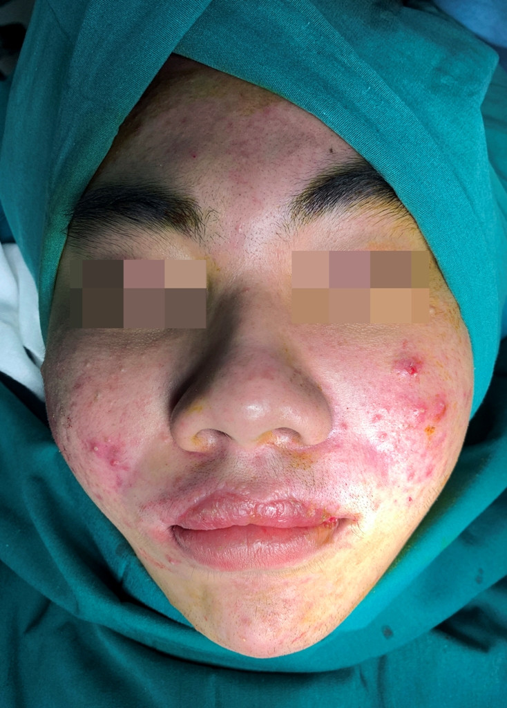 Kinh hoàng 10X tự tiêm silicon làm đẹp, trào chỗ nào dán 'keo con voi' chỗ đó ảnh 3