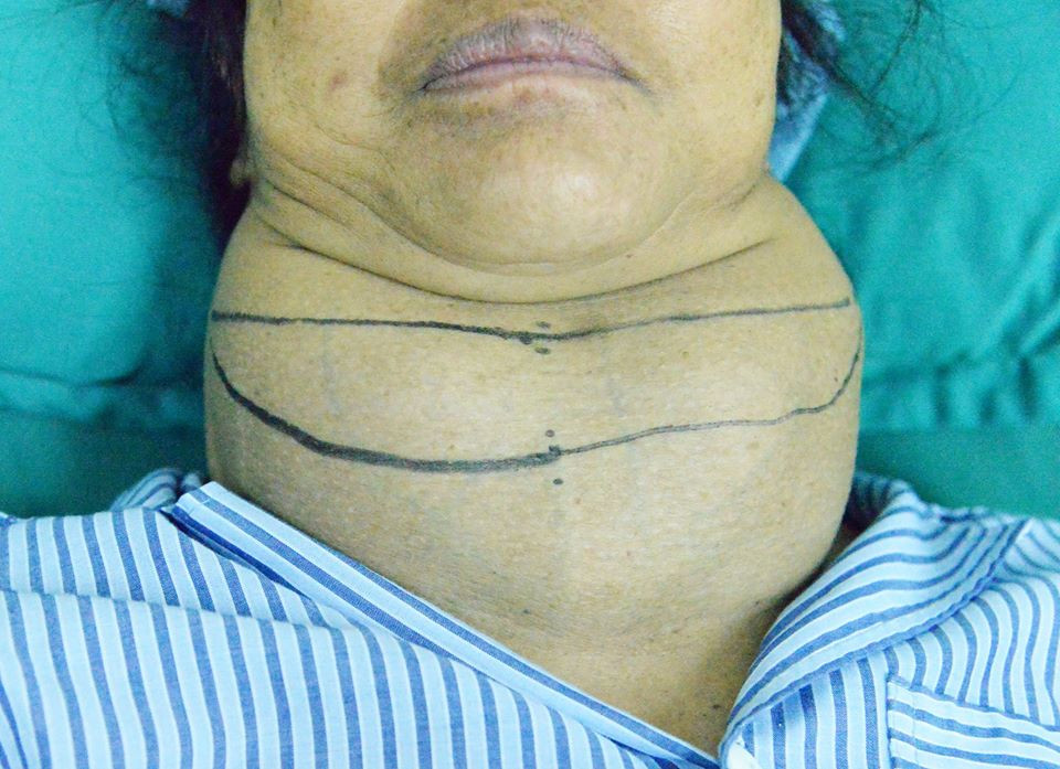 Người phụ nữ Sơn La mang bướu giáp khổng lồ suốt 10 năm ảnh 1