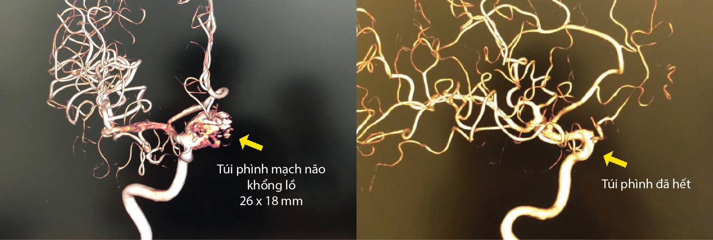 Loại bỏ hoàn toàn túi phình động mạch não lớn bằng phương pháp stent chuyển dòng ảnh 2