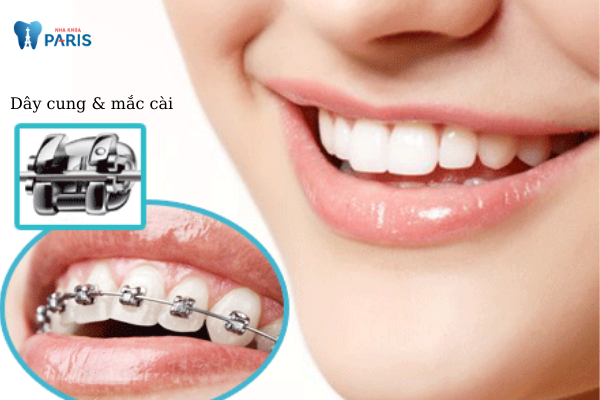 Nên lựa chọn niềng răng mắc cài kim loại thường hay tự buộc? ảnh 1