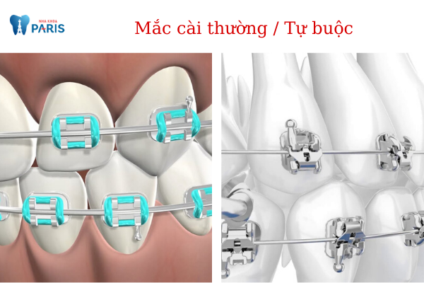Nên lựa chọn niềng răng mắc cài kim loại thường hay tự buộc? ảnh 2