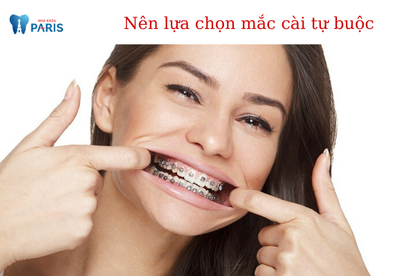 Nên lựa chọn niềng răng mắc cài kim loại thường hay tự buộc? ảnh 3