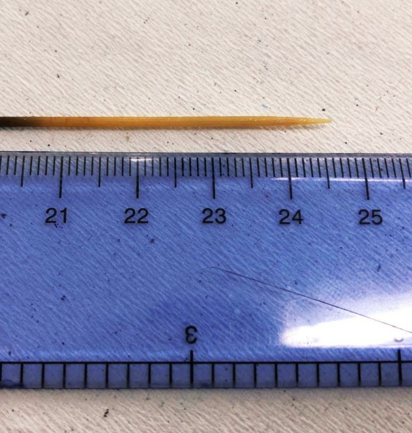 Suýt chết vì chiếc tăm 'chu du' trong ổ bụng ảnh 1