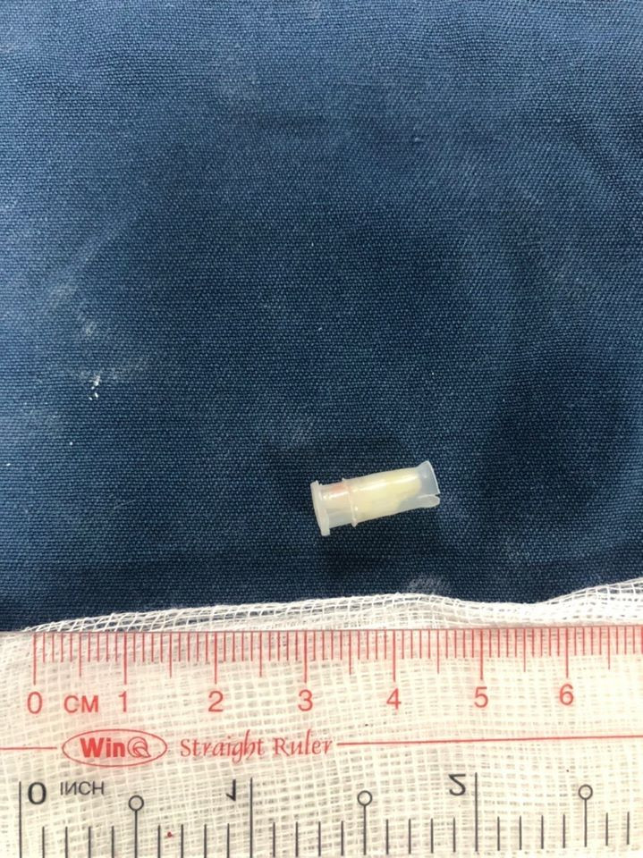 Bé 3 tuổi tắc thở, tím tái cả người vì món đồ chơi nhiều trẻ mê mẩn ảnh 1