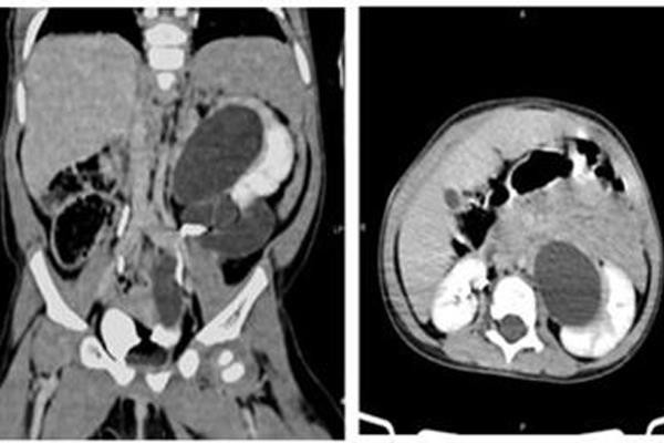 Phú Thọ: Bé gái 16 tháng tuổi có 3 quả thận ​ ảnh 1