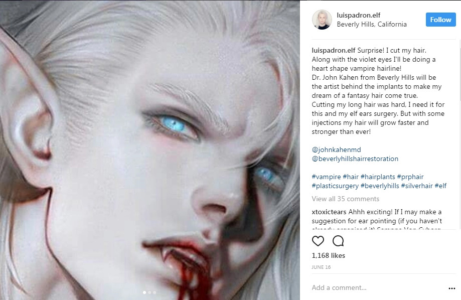 Chàng trai dành 5 năm để phẫu thuật thành yêu tinh ngoài đời thực ảnh 7