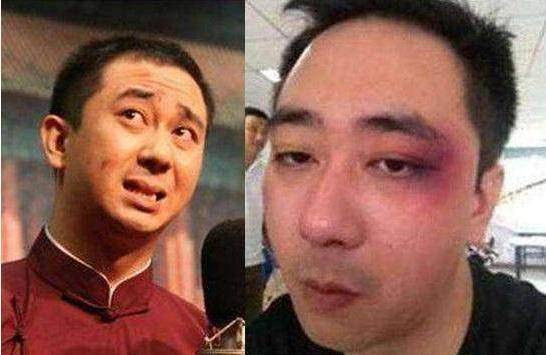 Hình ảnh bị đánh bầm dập mặt của Vương Tự Kiện. Diễn viên kiêm MC truyền hình Trung Quốc bị vợ tát 500 cái, nhập viện 8 lần ảnh 1