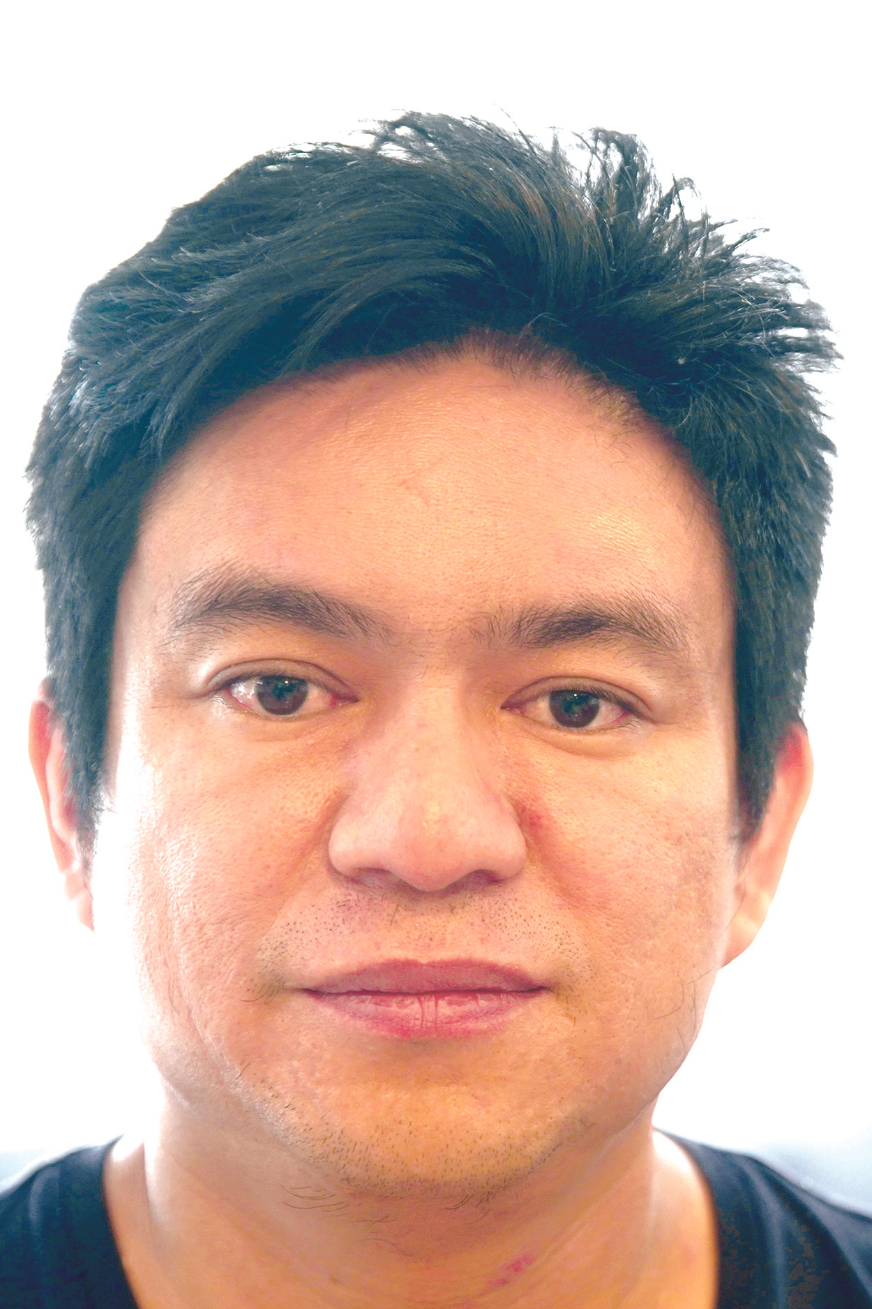 Căng da mặt chỉ Collagen, xu hướng trẻ hóa làn da hiện đại ảnh 3