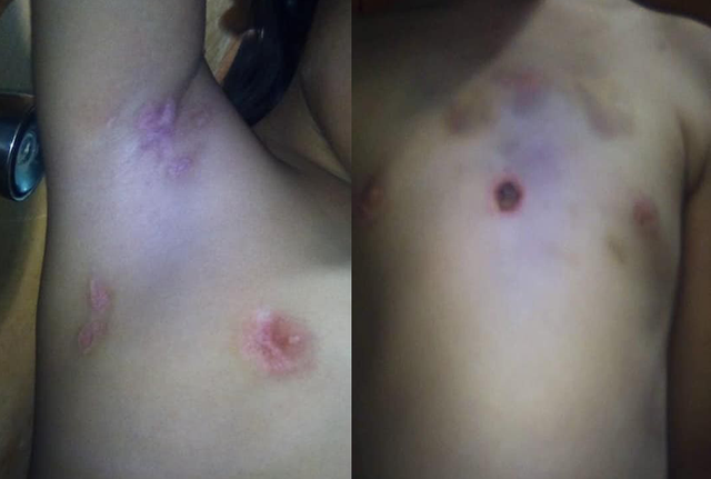 Bé gái 6 tuổi bị châm thuốc lá vào người ảnh 1