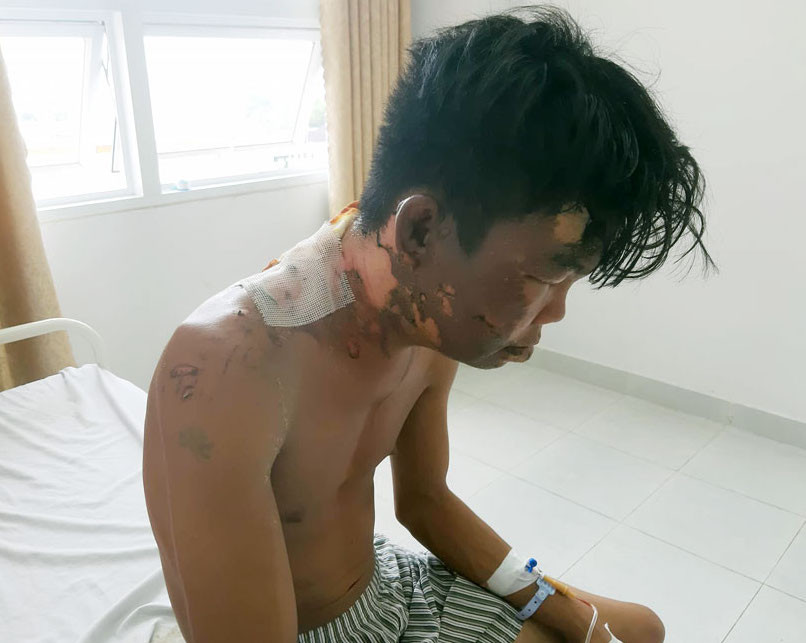 Thanh niên 24 tuổi bị chị gái đổ nồi nước sôi lên đầu ảnh 1