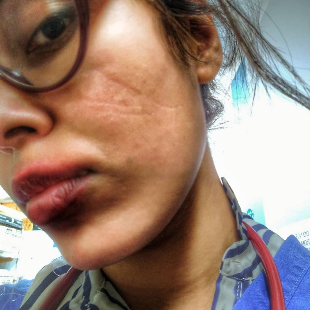 Hoa hậu Anh bị tổn thương mặt vì đeo khẩu trang quá nhiều khi làm bác sĩ chống COVID-19 ảnh 1