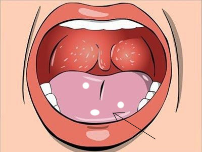 Nhiệt miệng, nhiệt lưỡi, nhiệt lợi tái phát – Xem ngay giải pháp ảnh 1