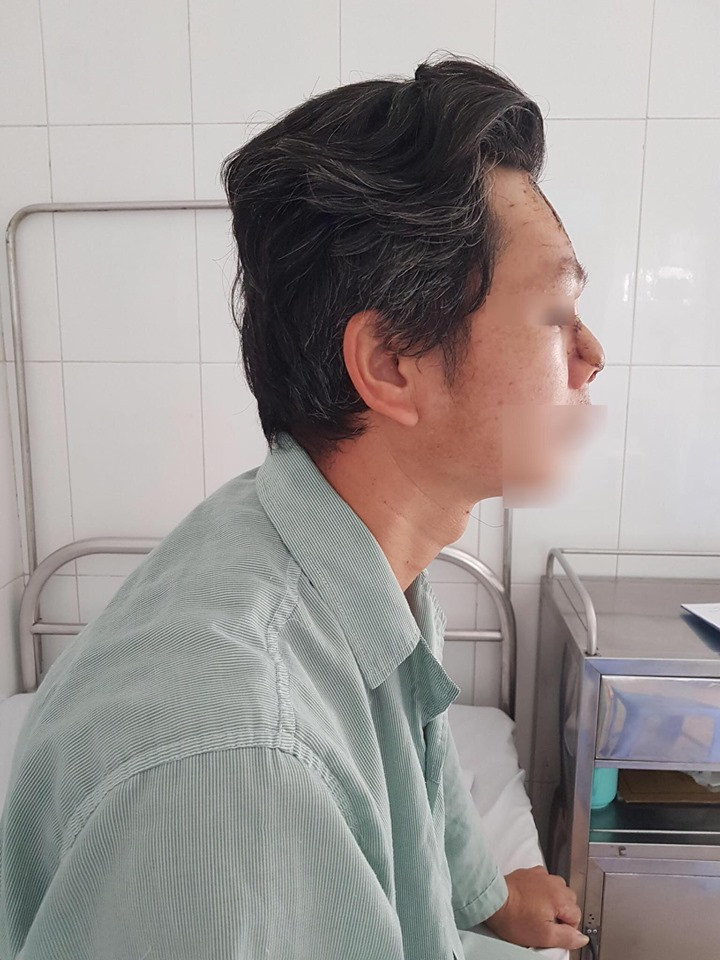 Kỳ diệu tái tạo mũi cho bệnh nhân ung thư bị xâm lấn đường thở ảnh 1