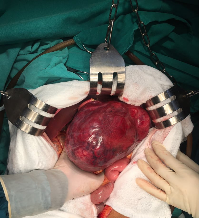 Mẹ con sản phụ ‘nghìn cân treo sợi tóc’ vì khối u gan nặng 3kg hiếm gặp trên thế giới ảnh 1