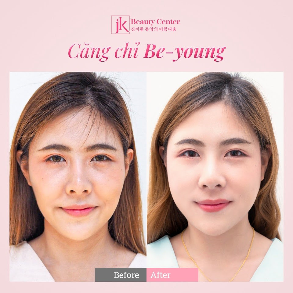 Phụ nữ Việt phát sốt với công nghệ căng chỉ Be- Young chuẩn y khoa đến từ Hàn Quốc ảnh 5