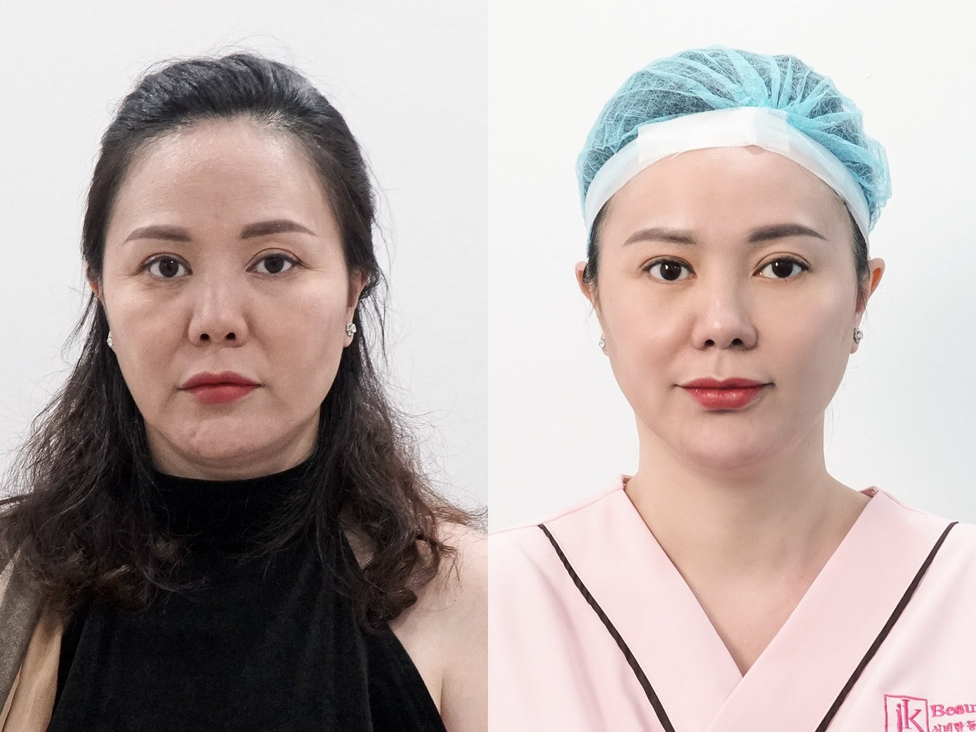 Phụ nữ Việt phát sốt với công nghệ căng chỉ Be- Young chuẩn y khoa đến từ Hàn Quốc ảnh 6