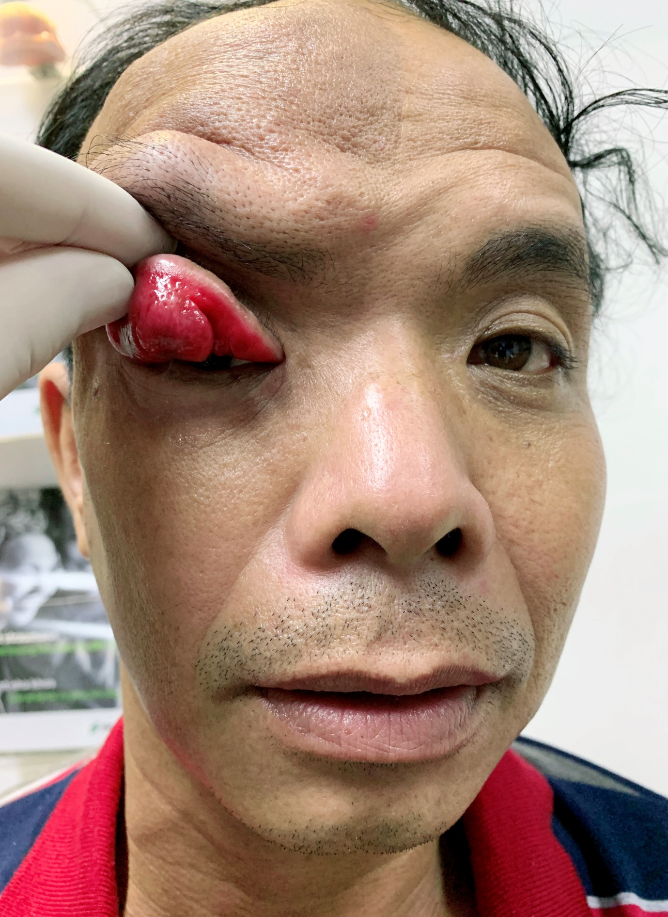 Cứu sống đôi mắt bị vùi lấp vì khối u chảy xệ đỏ tươi ảnh 1