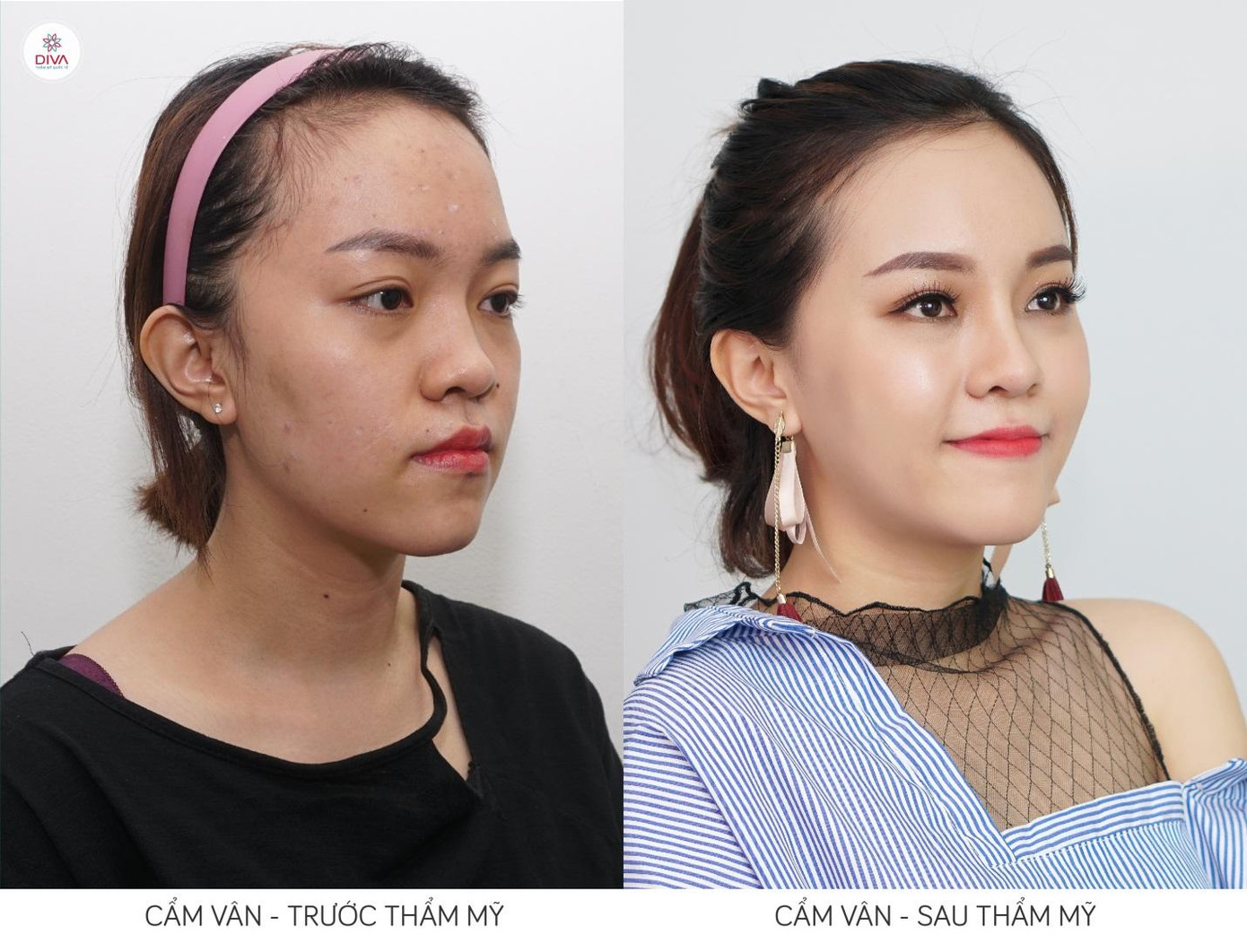 Có nên phẫu thuật thẩm mỹ theo tiêu chuẩn Tỷ lệ vàng? ảnh 4