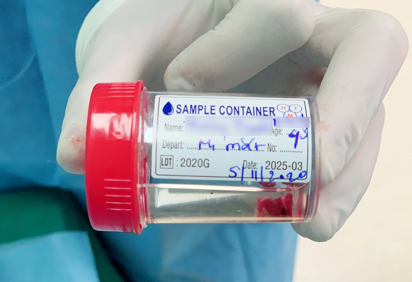 Cứu sống đôi mắt bị vùi lấp vì khối u chảy xệ đỏ tươi ảnh 6