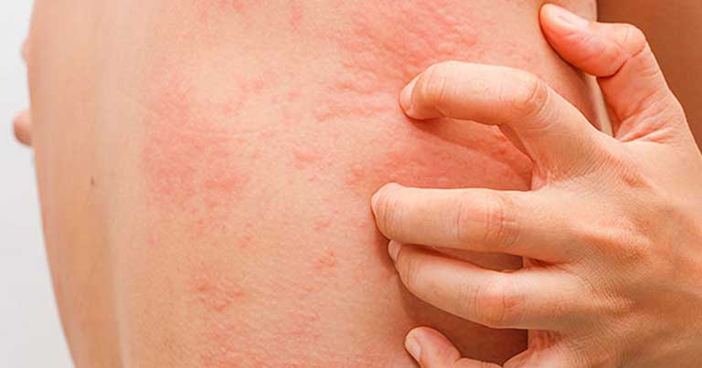 Liễu Hoàn Đan – Giải pháp hỗ trợ từ thiên nhiên cho người bị nóng nhiệt, nổi mề đay ảnh 1