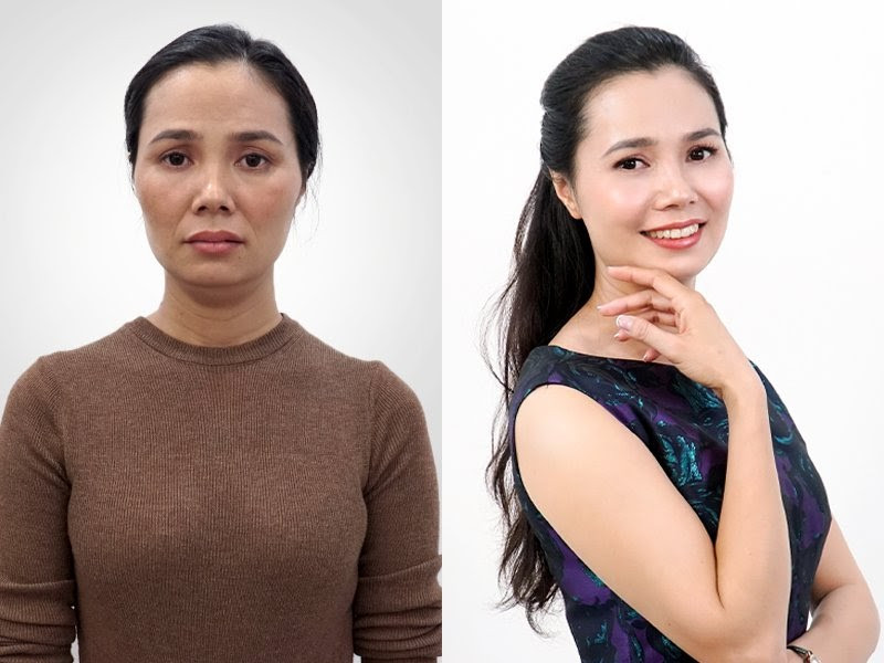 Phụ nữ Việt phát sốt với công nghệ căng chỉ Be- Young chuẩn y khoa đến từ Hàn Quốc ảnh 1