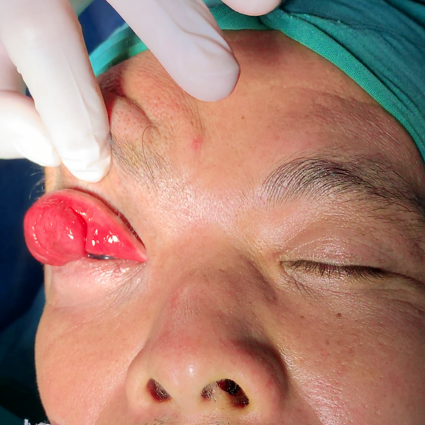 Cứu sống đôi mắt bị vùi lấp vì khối u chảy xệ đỏ tươi ảnh 3