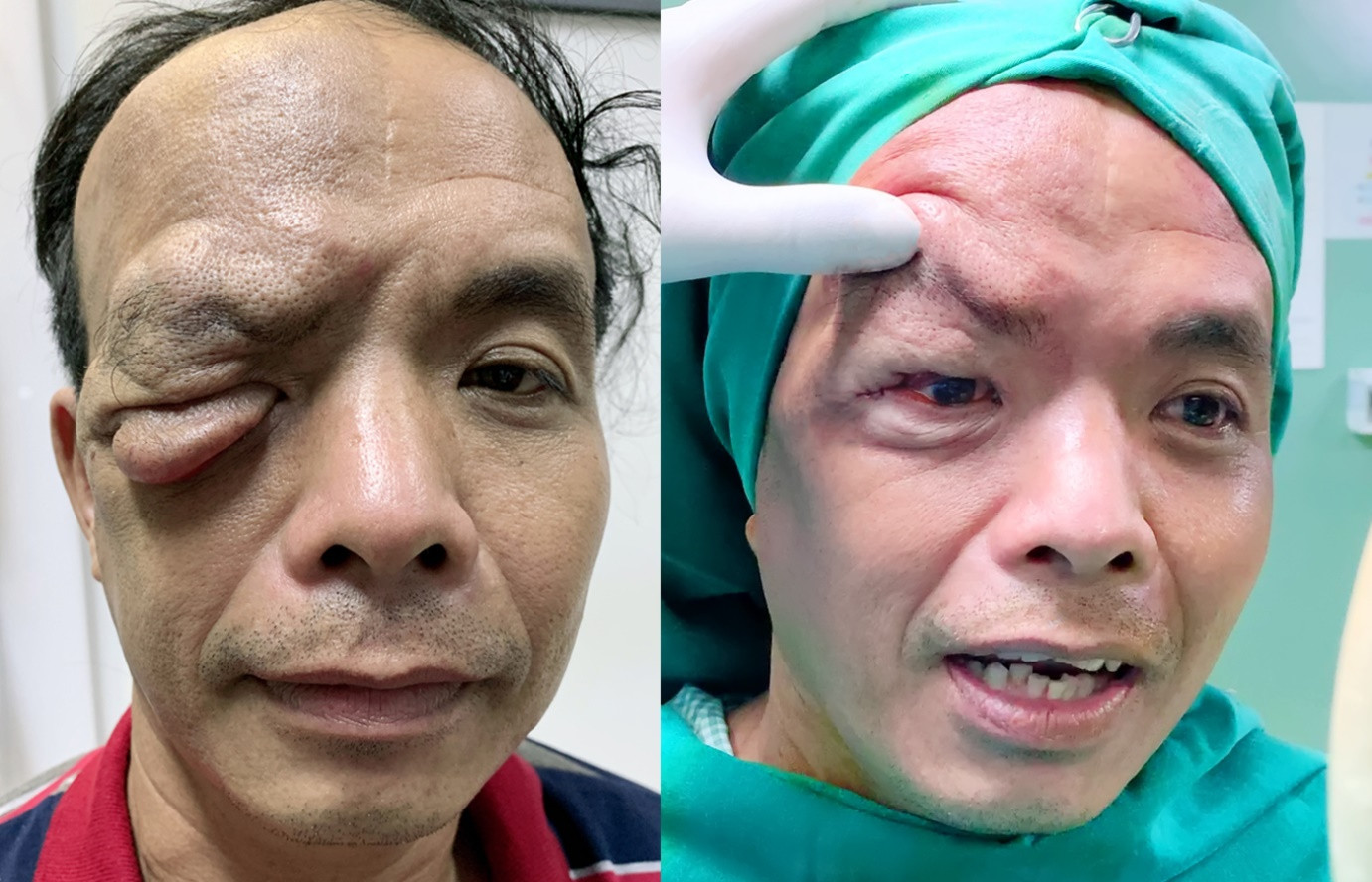 Cứu sống đôi mắt bị vùi lấp vì khối u chảy xệ đỏ tươi ảnh 5