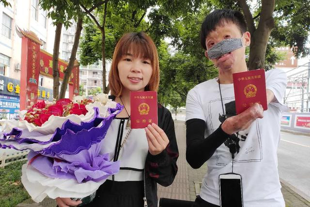 Câu chuyện cổ tích tình yêu của chàng trai bị hỏa hoạn hủy dung 85% và cái kết diệu kỳ ảnh 8