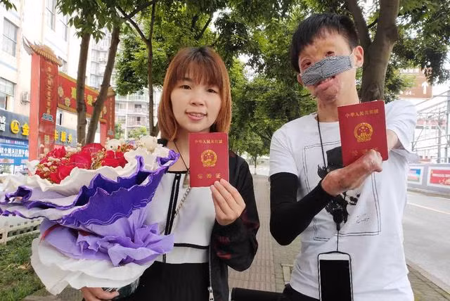 Câu chuyện cổ tích tình yêu của chàng trai bị hỏa hoạn hủy dung 85% và cái kết diệu kỳ ảnh 8