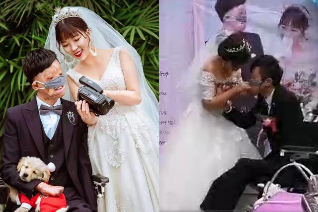 Câu chuyện cổ tích tình yêu của chàng trai bị hỏa hoạn hủy dung 85% và cái kết diệu kỳ ảnh 1