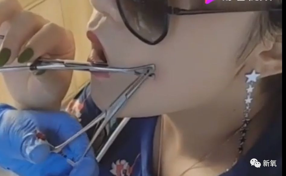 Cô gái trẻ 17 đóng đinh vào má để có má lúm đồng tiền như diễn viên Lê Tư ảnh 8