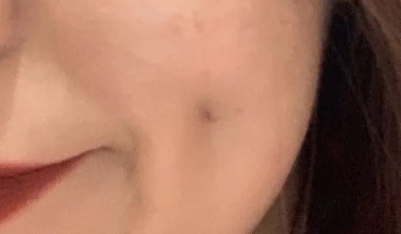 Cô gái trẻ 17 đóng đinh vào má để có má lúm đồng tiền như diễn viên Lê Tư ảnh 9