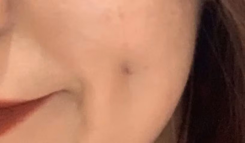 Cô gái trẻ 17 đóng đinh vào má để có má lúm đồng tiền như diễn viên Lê Tư ảnh 9