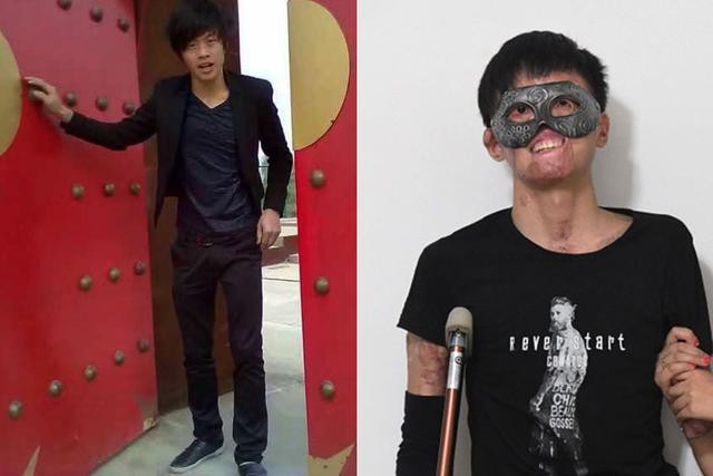 Câu chuyện cổ tích tình yêu của chàng trai bị hỏa hoạn hủy dung 85% và cái kết diệu kỳ ảnh 2