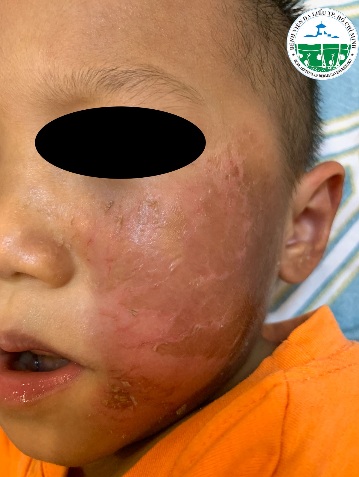 Bé trai 4 tuổi da bỏng rộp vì đồ chơi Halloween ảnh 1