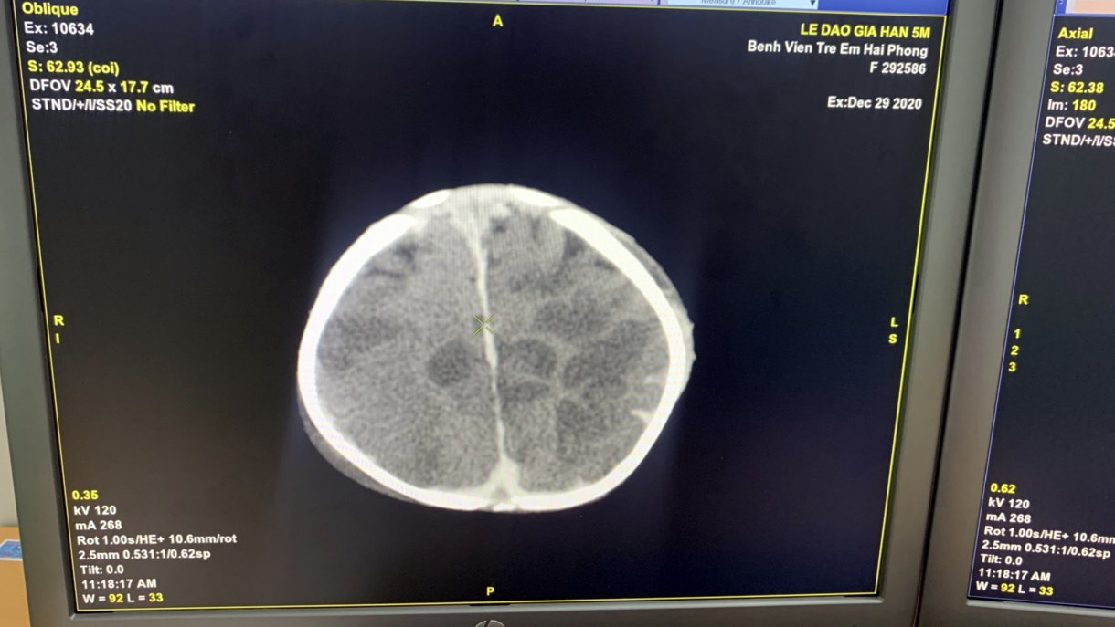 BV Nhi Hải Phòng thông tin việc 'chậm điều trị cho bệnh nhi xuất huyết não' ảnh 2