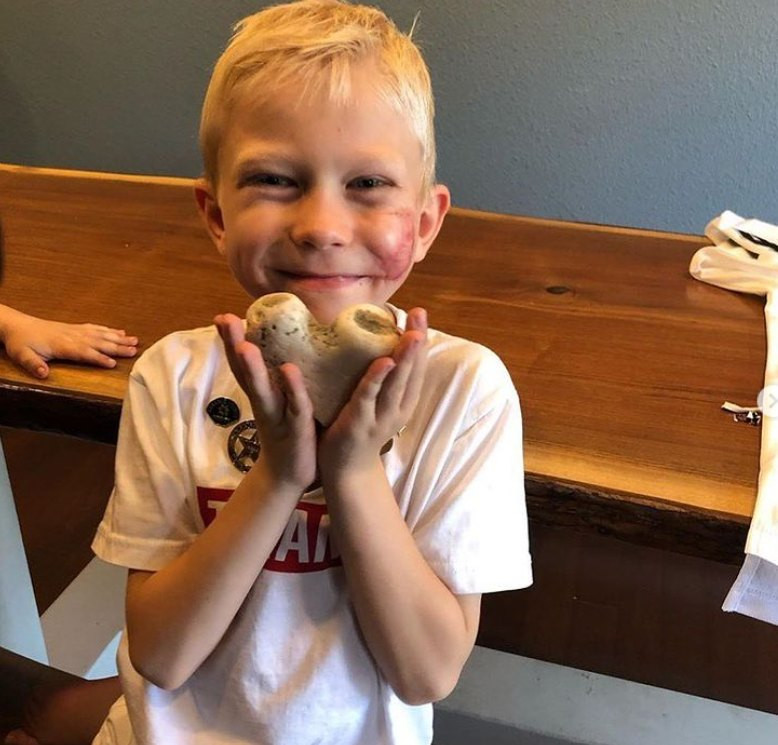 “Siêu anh hùng nhí" cứu em gái khỏi chó cắn được nhóm bác sĩ tình nguyện chữa sẹo miễn phí ảnh 1