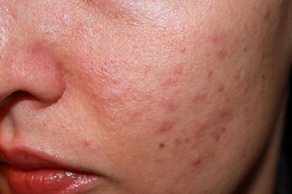 Bí quyết trị mụn cho làn da nhạy cảm ảnh 1