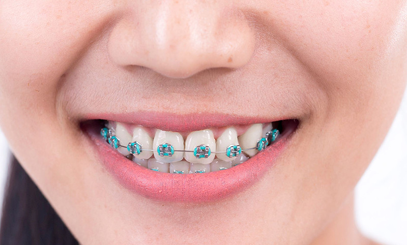 “Không thể để răng xấu suốt kiếp" - niềng răng không phiền phức như bạn tưởng! ảnh 3