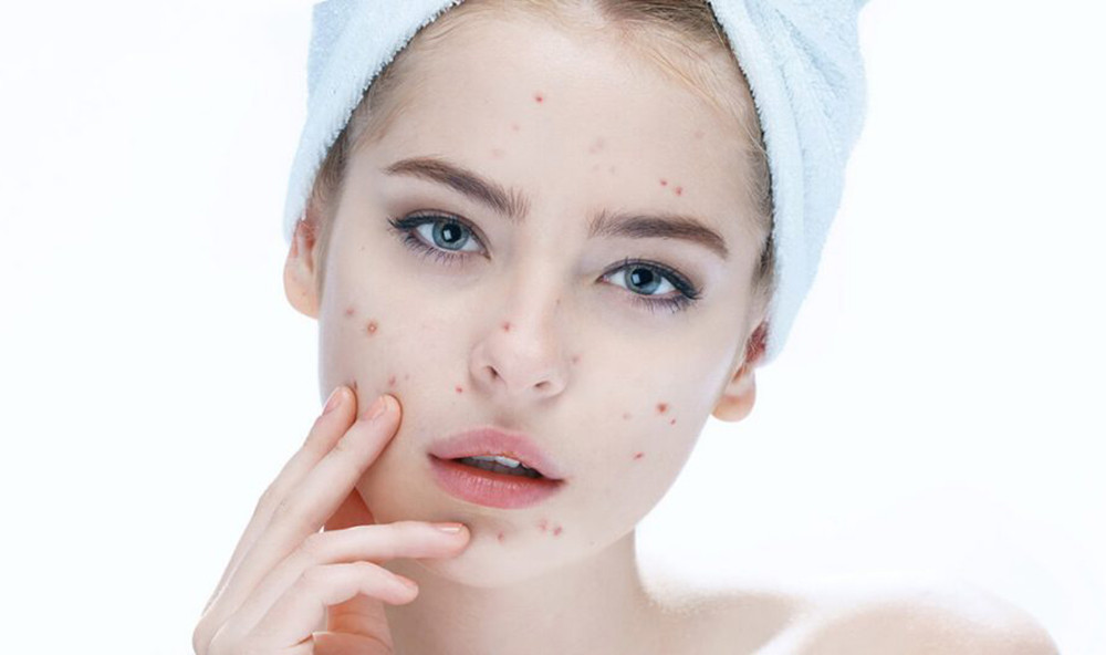 Những sai lầm khiến dùng thuốc trị mụn như bác sĩ kê rồi mà mãi vẫn không khỏi ảnh 1