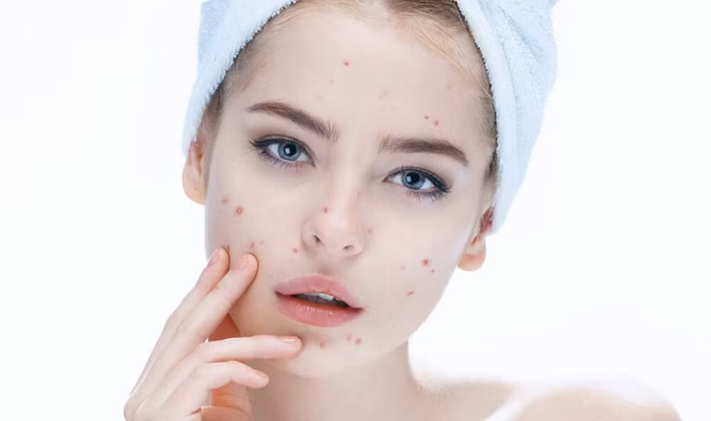 Những sai lầm khiến dùng thuốc trị mụn như bác sĩ kê rồi mà mãi vẫn không khỏi ảnh 1