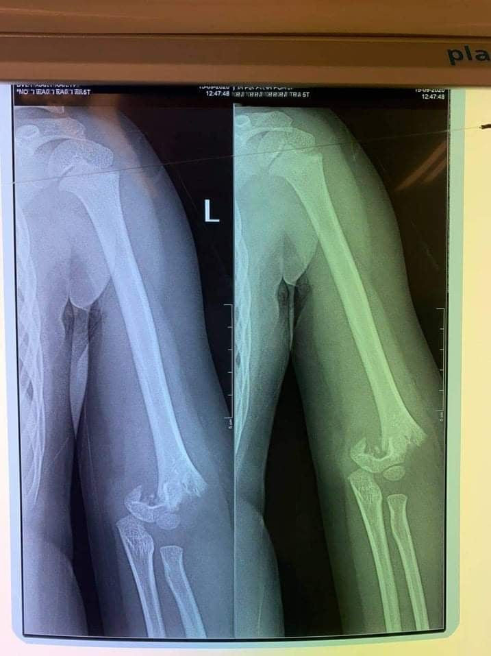 Sở GD&ĐT Hà Nội yêu cầu xác minh vụ trẻ mầm non bị gãy tay trong trường học ​ ảnh 1