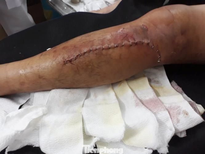 Lấy được tài sản cho người bị cướp, 'hiệp sĩ' bị đánh gãy chân ảnh 1