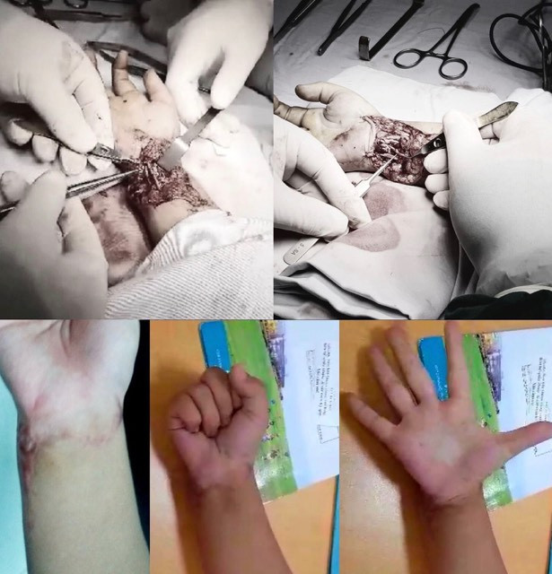 Đang tắm gặp tai nạn bất ngờ, bé trai 6 tuổi đứt gần lìa bàn tay ảnh 2